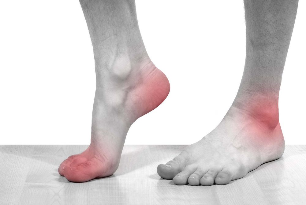 
Bệnh gout đau gót chân ảnh hưởng đến chất lượng cuộc sống của bệnh nhân
