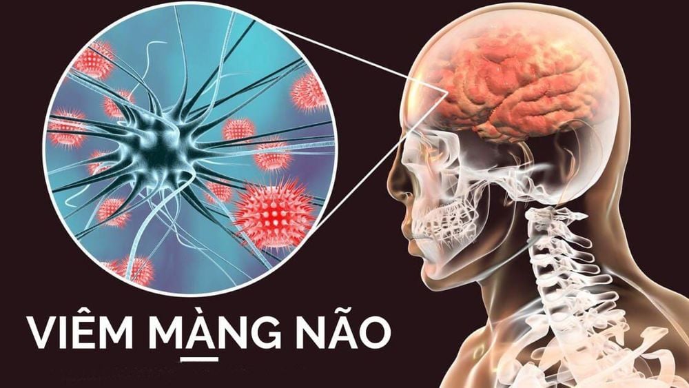 
Có nhiều nguyên nhân khác nhau gây bệnh viêm màng não
