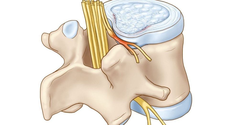 
Nguyên nhân co thắt cơ có thể do dây thần kinh cột sống bị chèn ép
