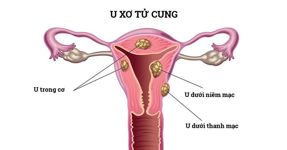 U xơ tử cung có thể gây cảm giác khó chịu ở vùng kín ở nữ giới