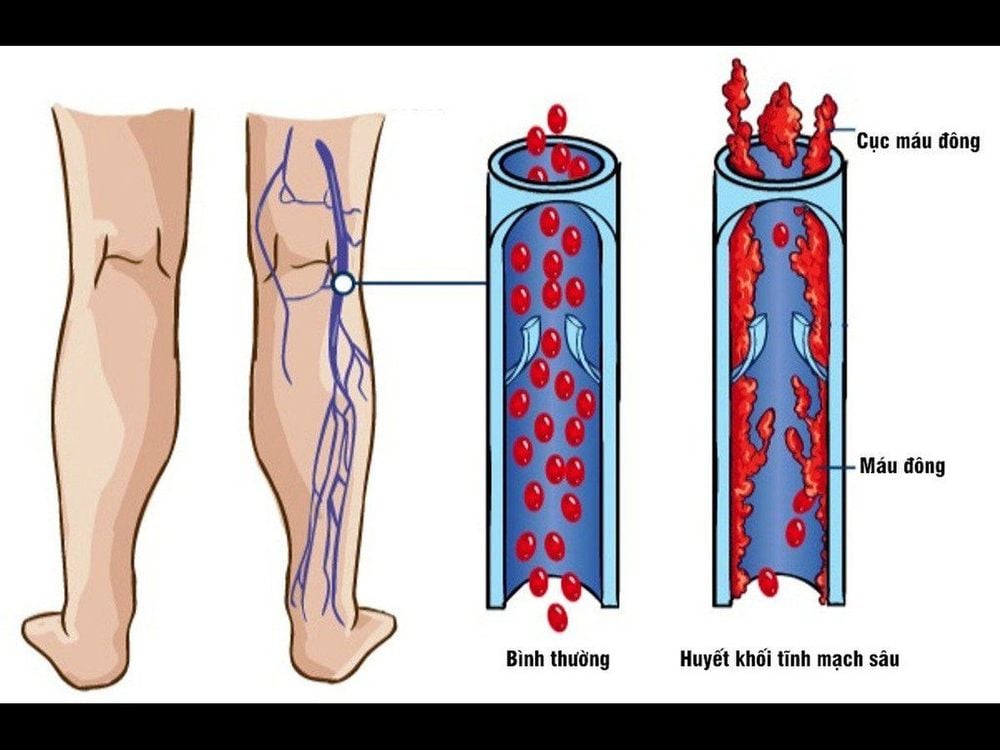 
Trong điều trị sưng mạch máu ở tay có trường hợp bệnh nhân bị huyết khối tĩnh mạch sâu cần phải sử dụng thuốc chống đông máu
