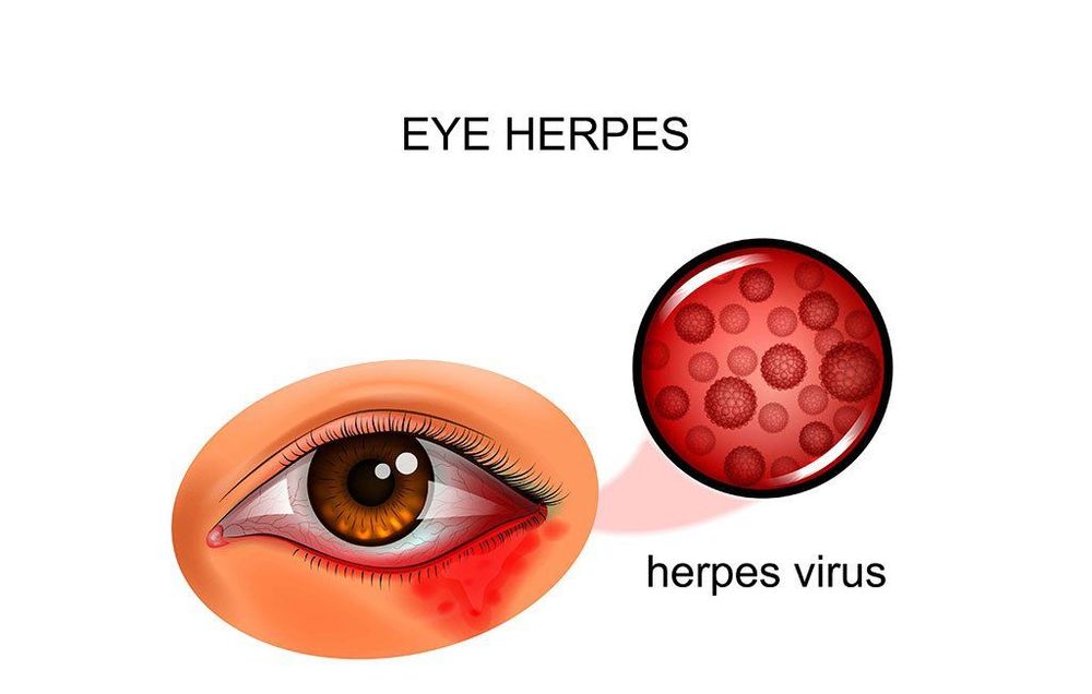 
vi-rút herpes gây viêm nhiễm trên mắt có thể làm sưng mí mắt trên
