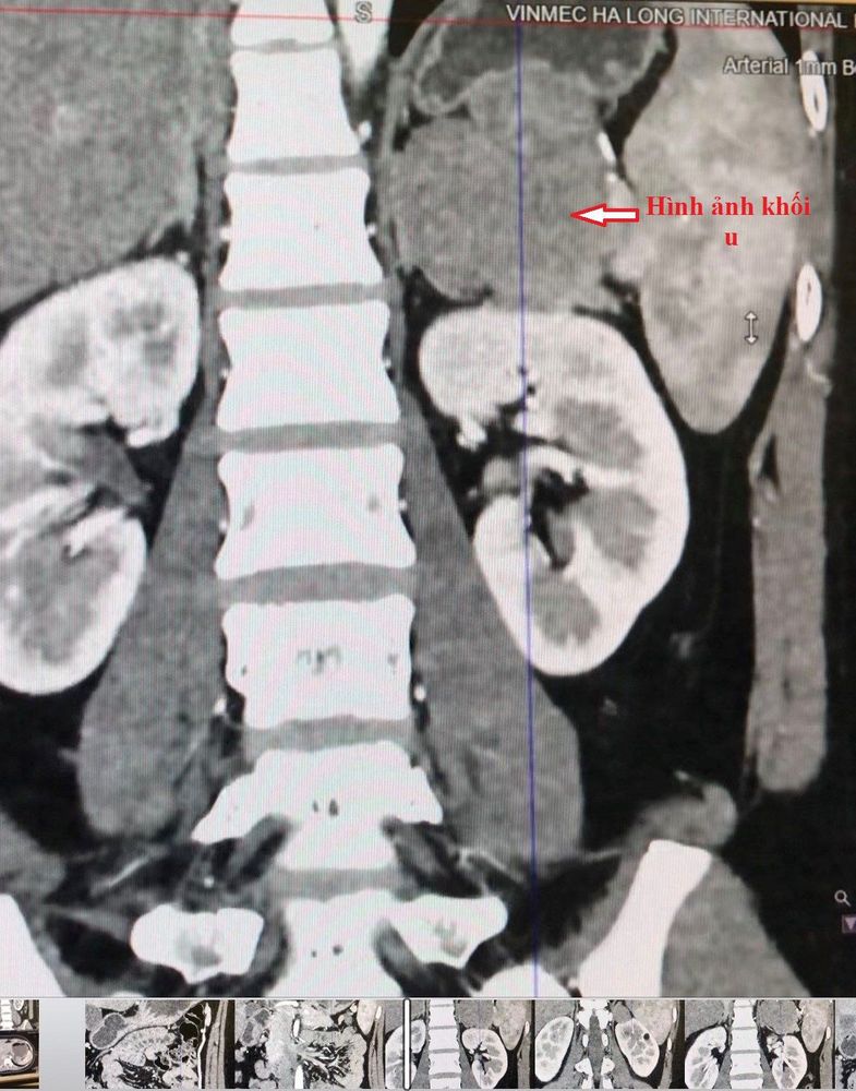 
Pancreatic low-grade pseudopapillary tumor as shown on a CT scan
