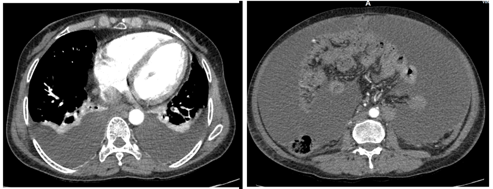 
Prior to treatment, the patient had significant abdominal and bilateral pleural effusions.
