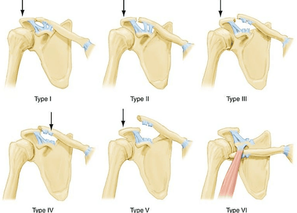 Arthroscopic shoulder surgery for acute acromioclavicular joint dislocation treatment