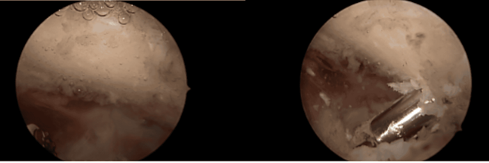 
Endoscopic image of the crow's process (left) and a burr (right)
