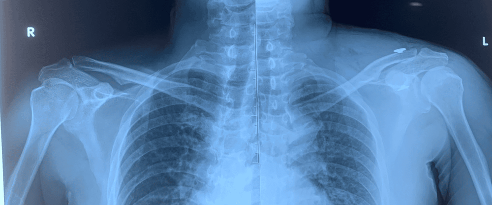 
X-ray picture Following surgery, the left clavicle joint was in the same place as the right one.
