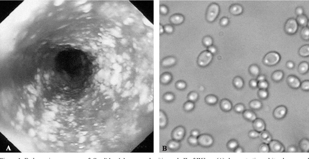 Hình ảnh nấm Candida soi tươi