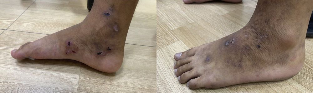 Bệnh mạch dạng mạng lưới (Livedoid vasculopathy)