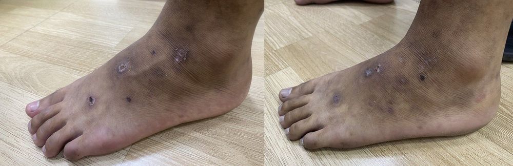 Bệnh mạch dạng mạng lưới (Livedoid vasculopathy)