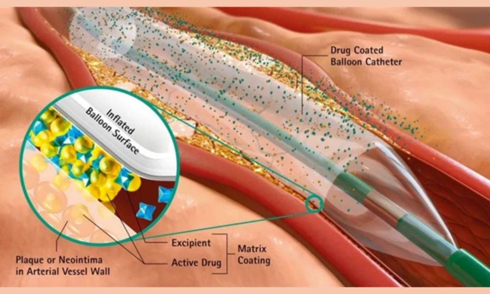 Cấu tạo bóng phủ thuốc động mạch vành