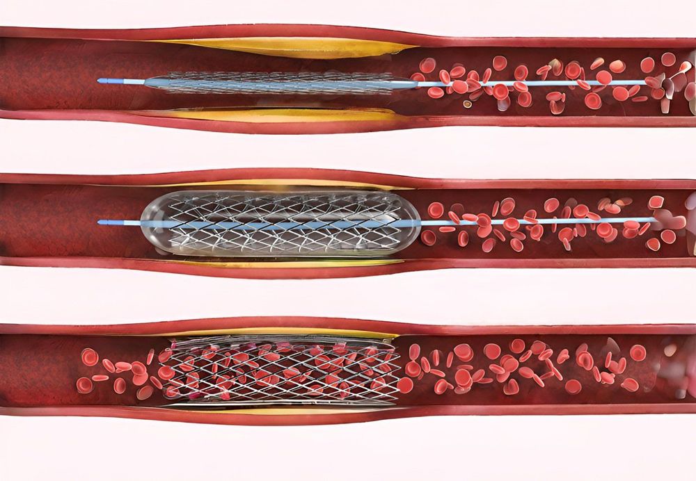 
Can thiệp động mạch vành bằng stent
