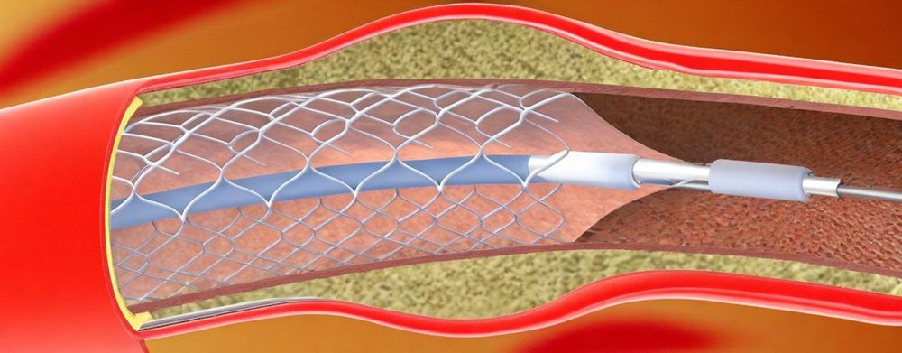 
Đặt stent không phù hợp với mọi trường hợp thiếu máu cơ tim
