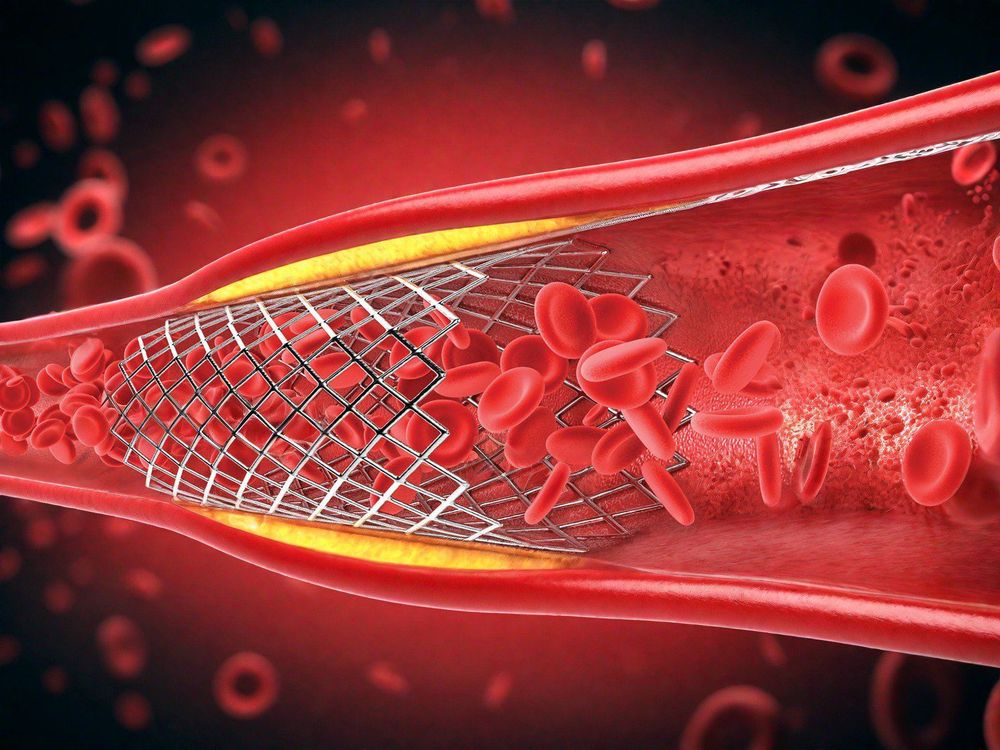 
Đặt stent mạch vành để giúp tăng lưu lượng máu đến tim
