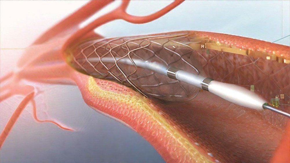 
Nong mạch bằng stent để cải thiện lưu thông máu cho bệnh tim to
