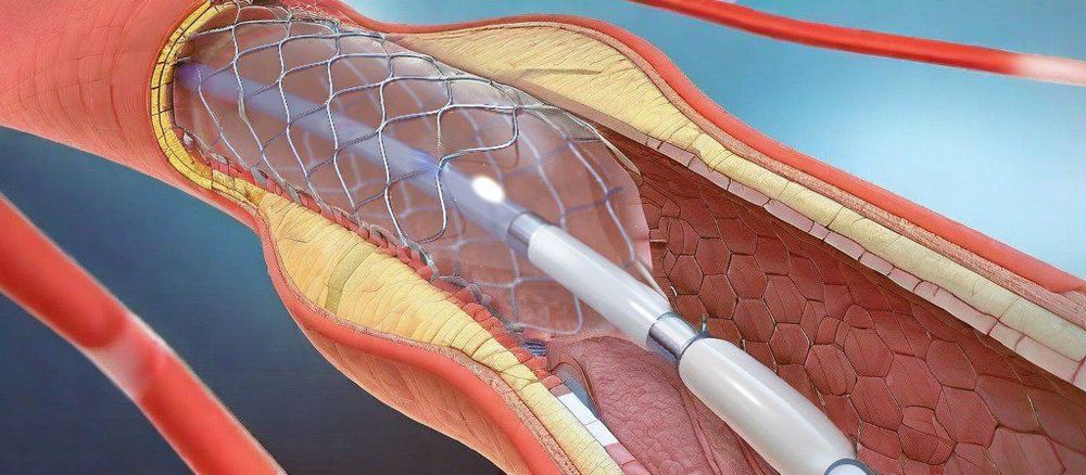 
Đặt stent là phương pháp mở rộng mạch vành, tăng lưu lượng máu
