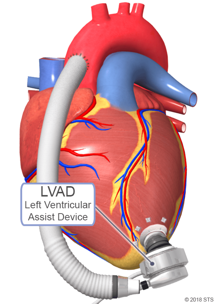 
Thiết bị hỗ trợ tâm thất trái (LVAD): Rủi ro và lợi ích cần biết
