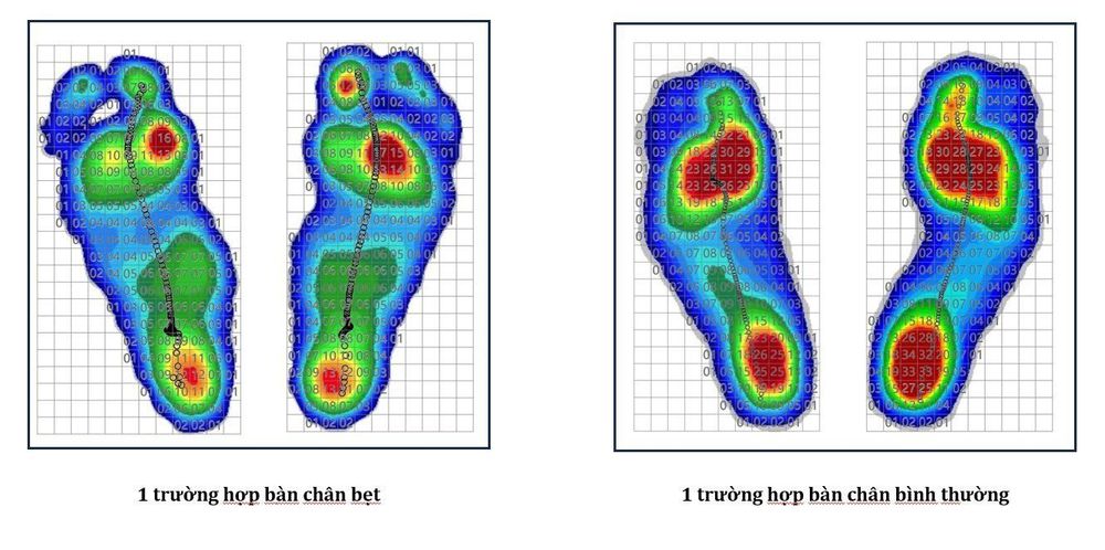 Tìm hiểu hội chứng bàn chân bẹt