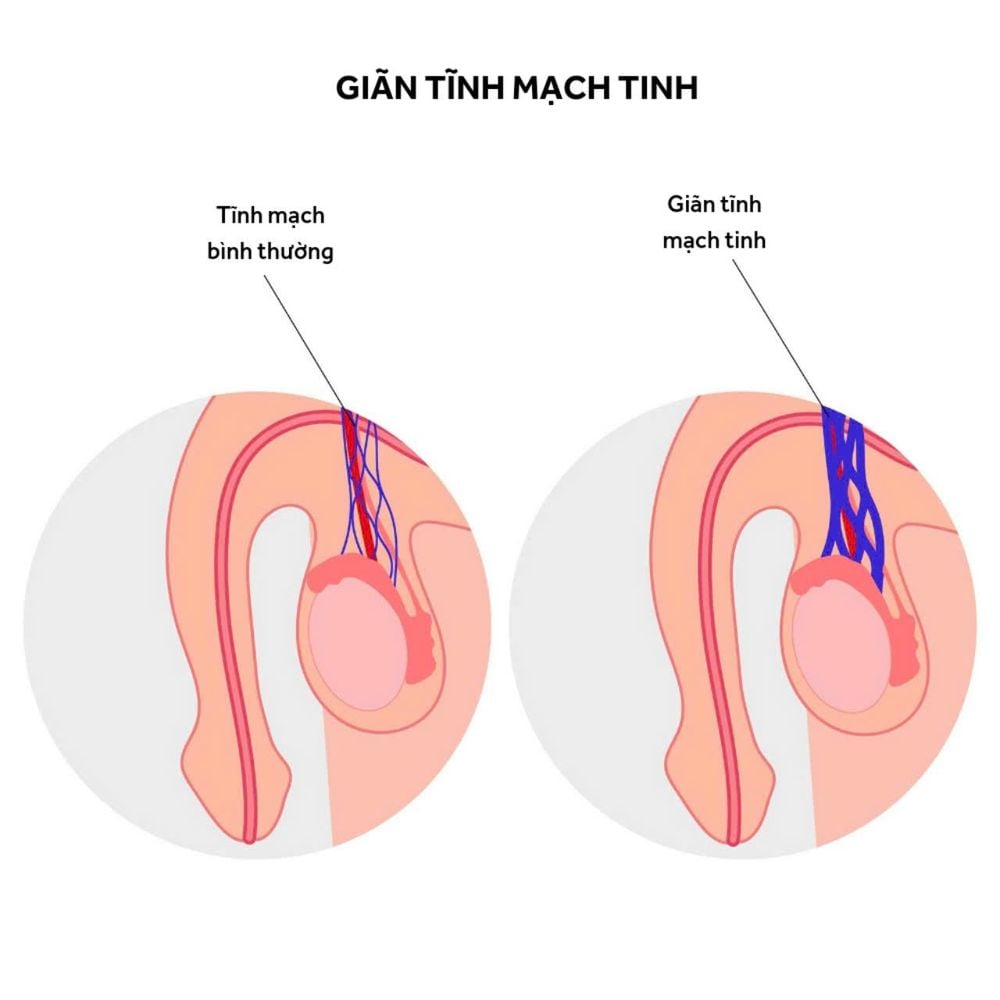 Hình ảnh minh họa giãn tĩnh mạch tinh (Nguồn ảnh: Shutter Stock)