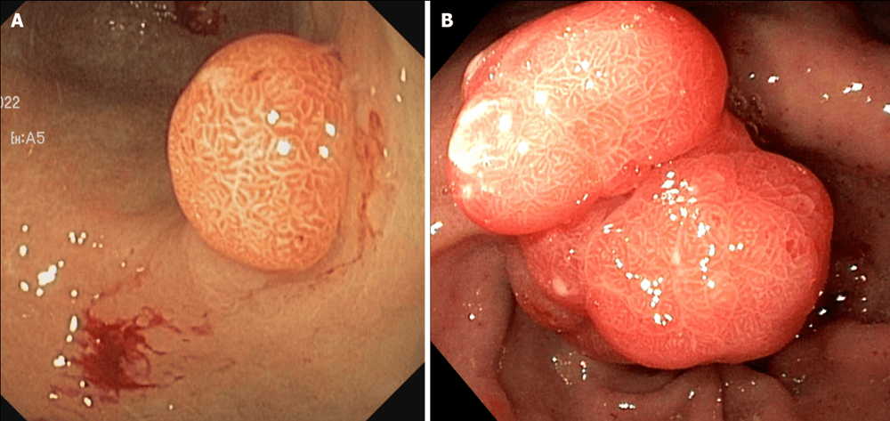 Polyp tăng sản hang vị. A: Nhỏ không cuống; B: Polyp khổng lồ