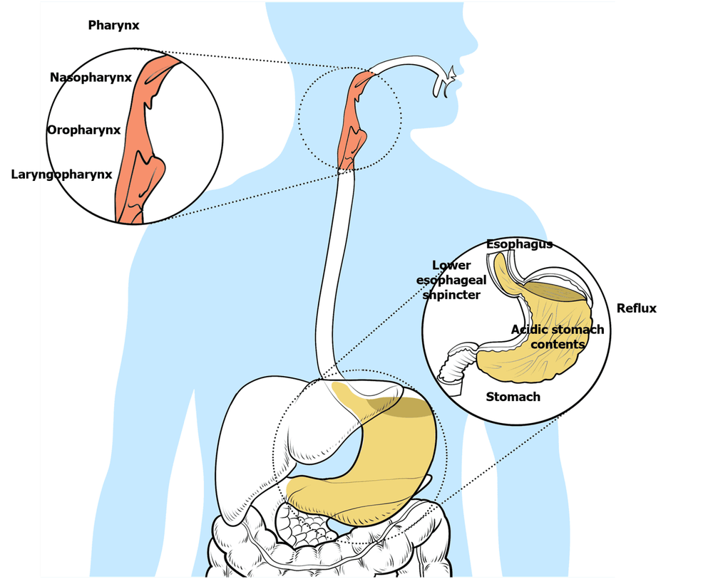 Điều trị không phẫu thuật trào ngược thanh quản hầu