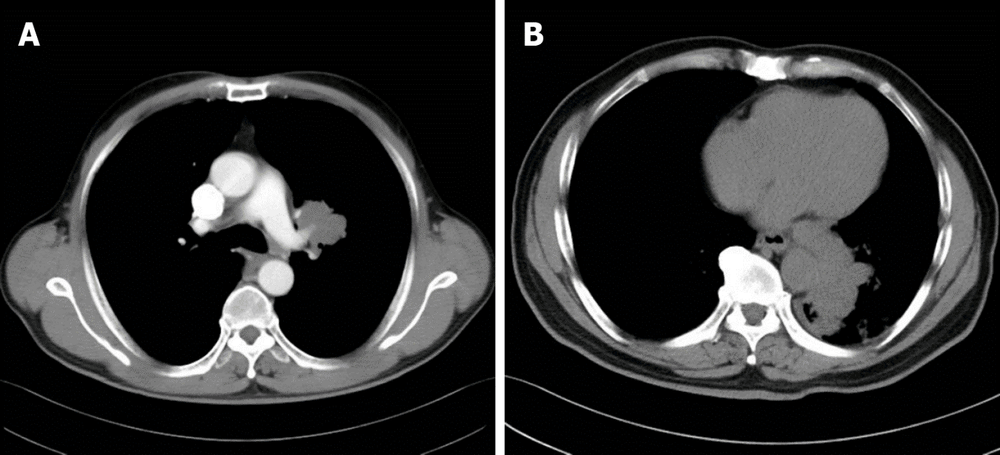 Hình 1 Hình ảnh chụp cắt lớp vi tính ngực. A: Một khối u có kích thước khoảng 5,0 cm × 4,0 cm ở vùng rốn phổi trái (trường hợp 1); B: Một khối u có kích thước khoảng 7 cm × 3 cm ở thùy dưới phổi trái (trường hợp 2)