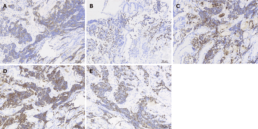 Kết quả hóa mô miễn dịch tổn thương của một số trường hợp. A: Biểu hiện dương tính của CD56; B: Biểu hiện dương tính của yếu tố phiên mã tuyến giáp; C: Biểu hiện dương tính của chromogranin A; D: Biểu hiện dương tính của synaptophysin; E: Nhuộm miễn dịch mô hóa học hiển thị Ki-67 (70%); A-D: Độ phóng đại, × 200