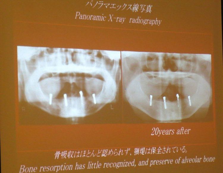 Giới thiệu phương pháp sử dụng hàm tháo lắp overdenture kết nối nam châm trong phục hình răng