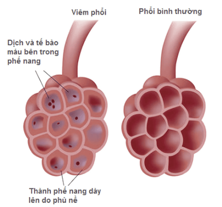 
Viêm phổi là tình trạng phổi bị tổn thương do sự tấn công của vi khuẩn, virus, ký sinh trùng, nấm
