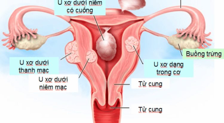 
Nguyên nhân chính gây ra bệnh u xơ tử cung khi mang thai vẫn chưa được xác định rõ ràng
