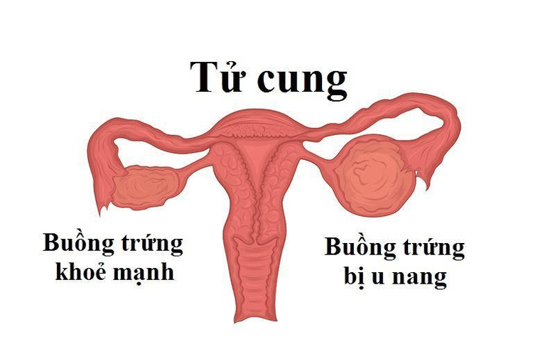 
Bị u nang cơ năng một bên vẫn có khả năng mang thai bình thường.
