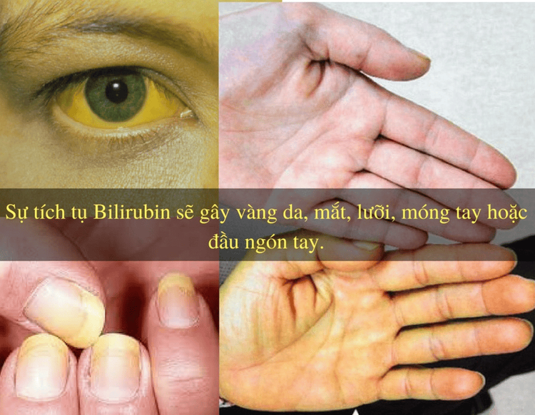 
Sỏi gan khiến da bị vàng.
