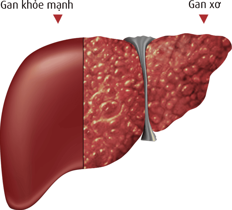 
Một trong các biến chứng của bệnh sỏi đường mật trong gan chính là xơ gan.
