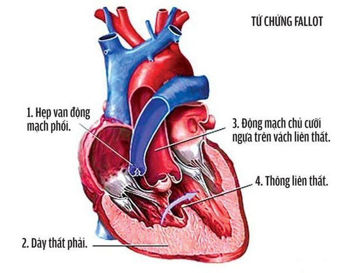 
Bốn tổn thương của Tứ chứng Fallot
