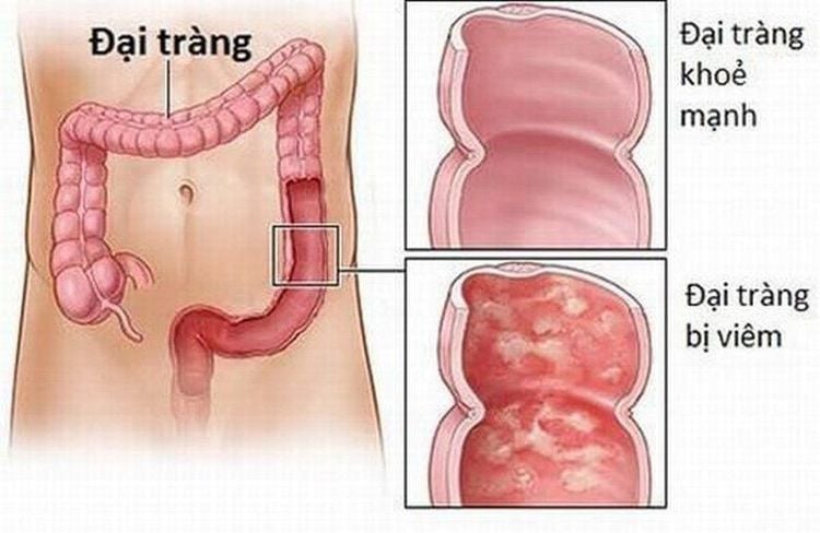 
Viêm đại tràng co thắt hay hội chứng ruột kích thích.
