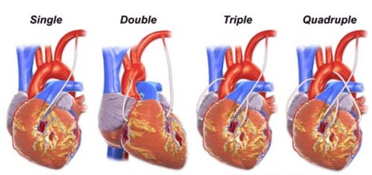 
Hình ảnh các mạch máu cầu nối ở vị trí trước và sau chỗ tắc nghẽn.
