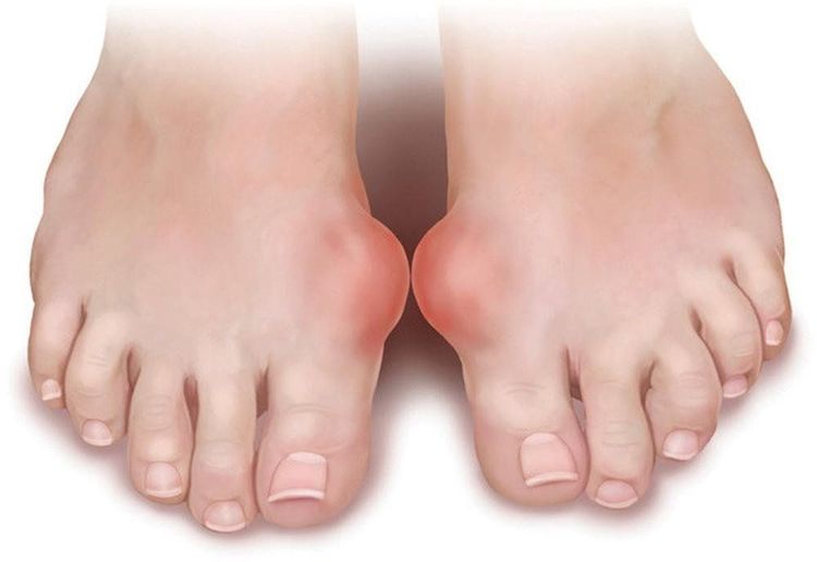 
Biểu hiện cơn Gout cấp
