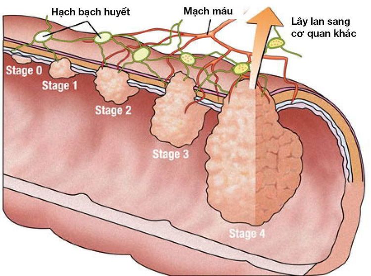 
Ung thư đại trực tràng được phân chia thành 4 giai đoạn
