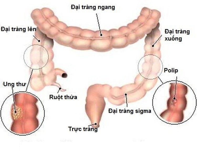 
Ung thư đại trực tràng là một u ác tính xuất phát từ đại tràng hoặc trực tràng
