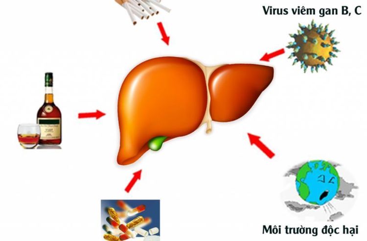 
Nguy cơ mắc ung thư gan ở người nghiện rượu bia cao hơn 4-5 lần người bình thường
