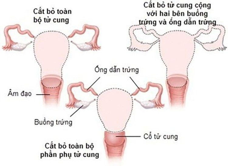 
Cắt tử cung toàn phần được chỉ định cho từng trường hợp cụ thể
