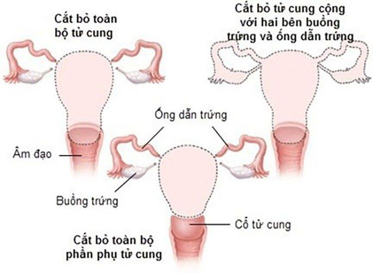 Cắt tử cung hoàn toàn qua nội soi - Thời gian hồi phục nhanh, không để lại sẹo xấu trên thành bụng