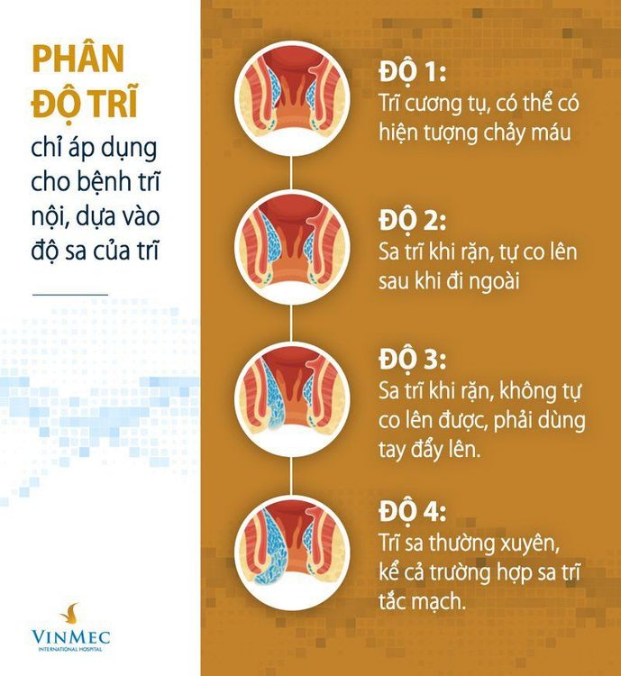 
Bệnh trĩ nội được chia làm 4 độ, mỗi phân độ đều có những biểu hiện khác nhau:
