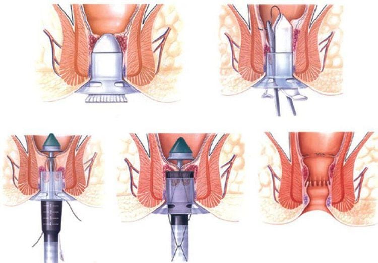 Cắt trĩ bằng phương pháp Longo