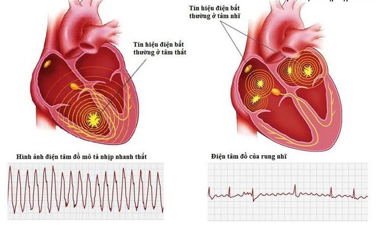 
Rối loạn nhịp tim là một tai biến có thể gặp khi gây mê nội khí quản phẫu thuật chỉnh gù vẹo cột sống
