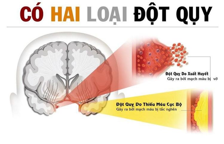 
Có hai loại gây đột quỵ
