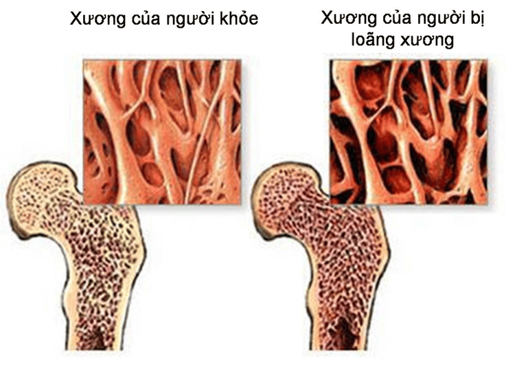 
Hình ảnh mô phỏng xương của một người bình thường và người bị loãng xương
