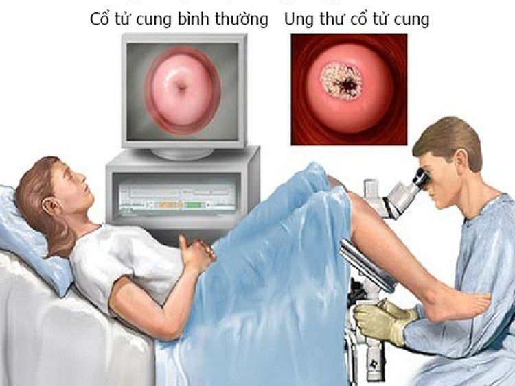 
Ung thư cổ tử cung là nguyên nhân hàng đầu gây tử vong ở nữ giới
