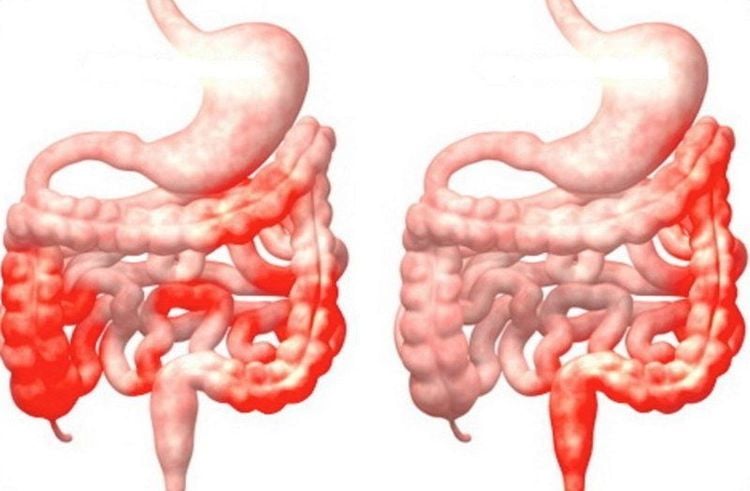 
Những người mắc bệnh Crohn hoặc viêm loét đại tràng có nguy cơ mắc ung thư đại trực tràng
