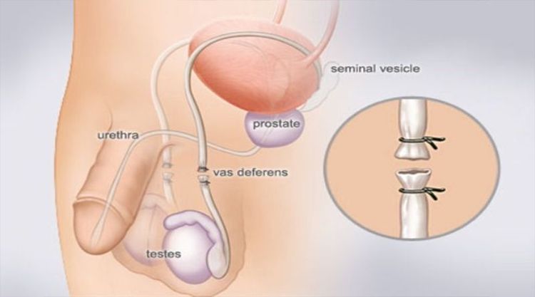 
Khi vợ hoặc chồng mắc bệnh có thể di truyền có thể sinh ra những đứa con không khỏe mạnh
